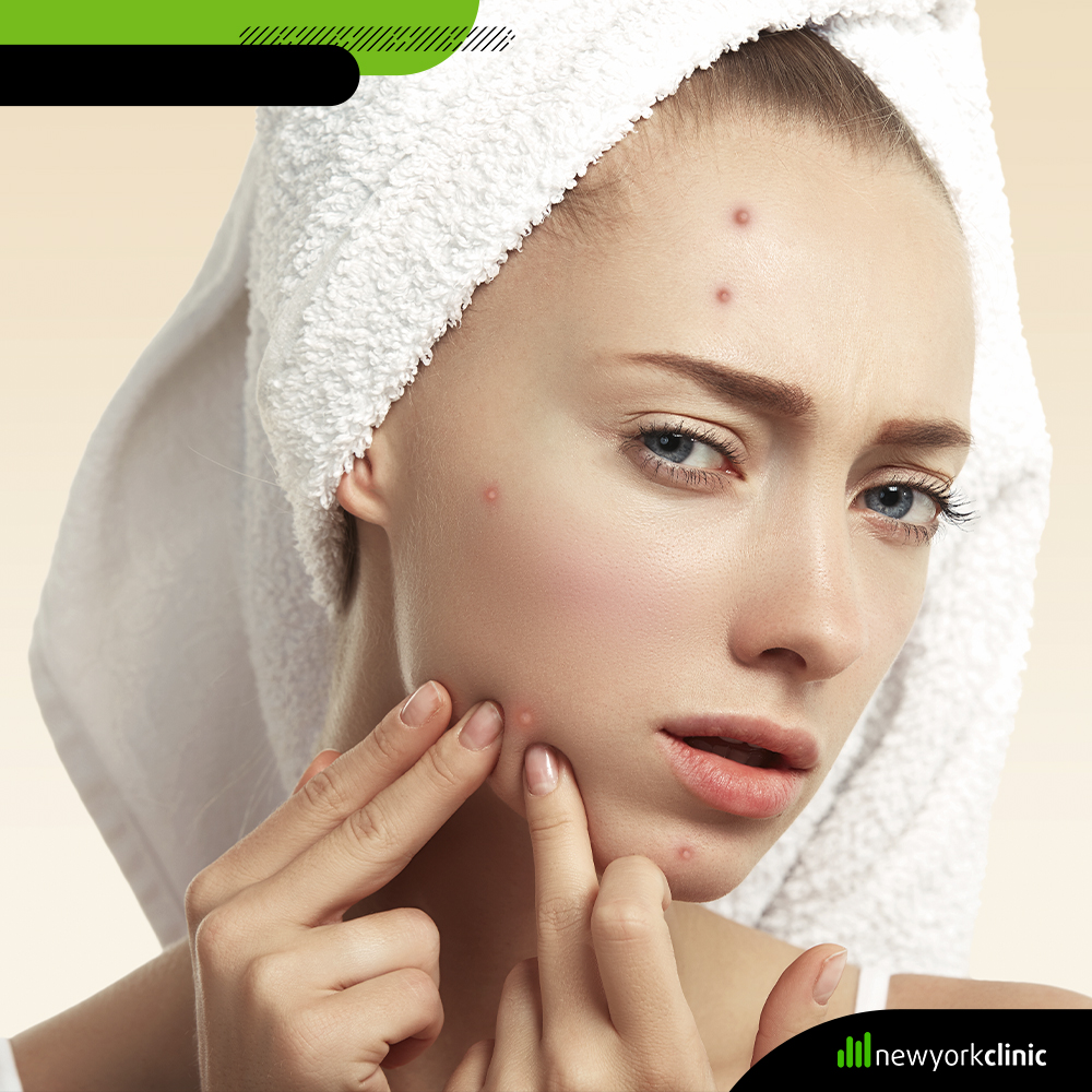 Te contamos cuál es la causa del acné dependiendo de la zona donde aparezca