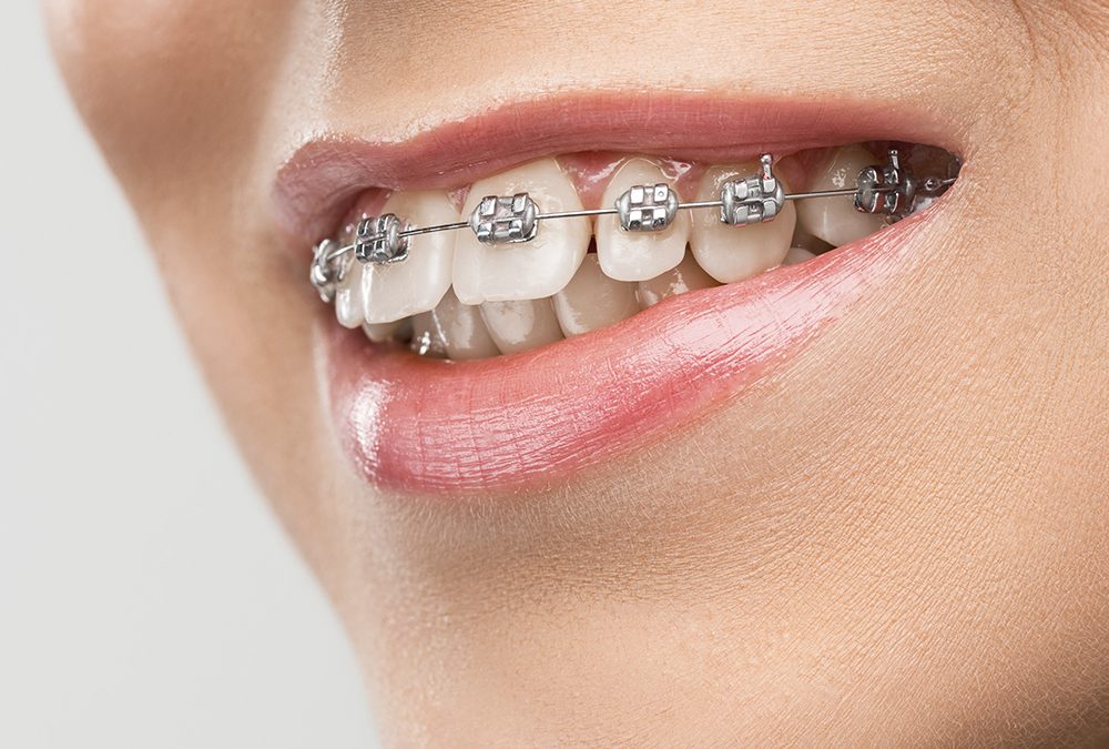 Sonrisas desalineadas (maloclusión) y todo lo que debes saber sobre ellas